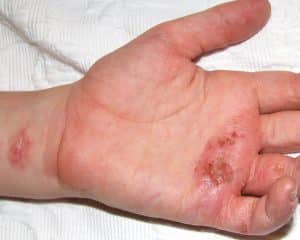 Eczema on wrist, hand, and fingers