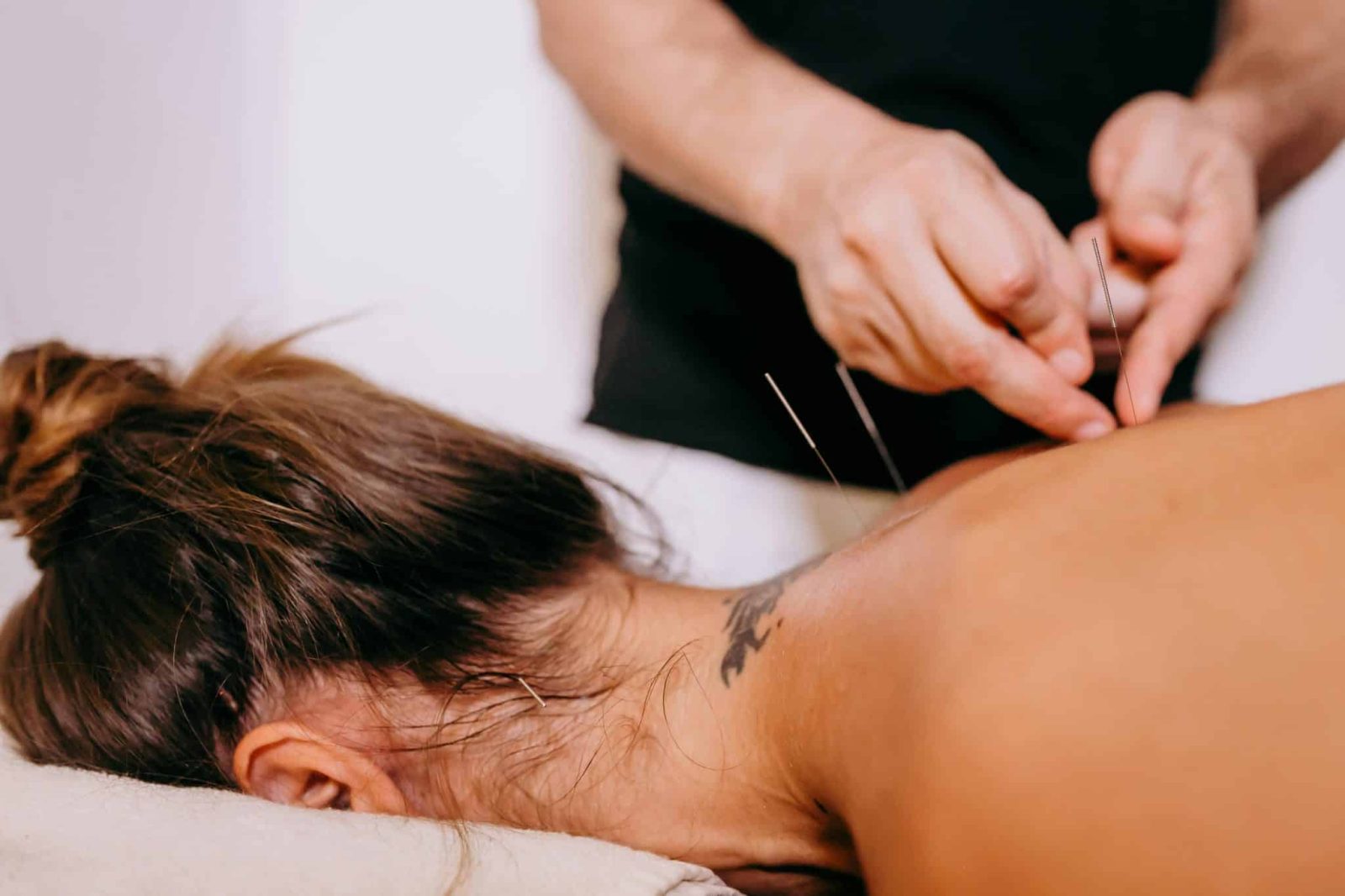 woman receiving acupuncture on her back