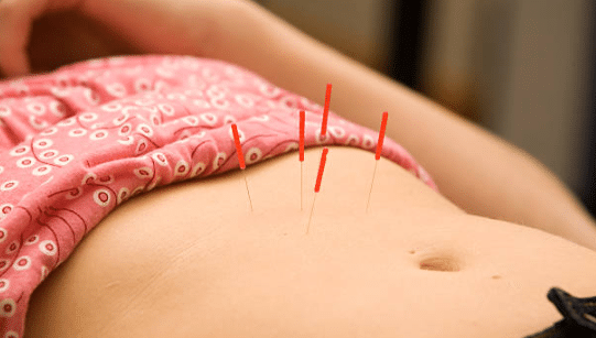 Acupuncture in stomach. How to lose weight fast naturally and permanently without weight loss aids.